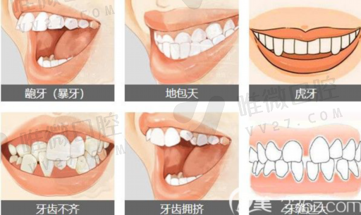 树脂补牙的缺点（树脂补牙有什么后遗症）(图1)